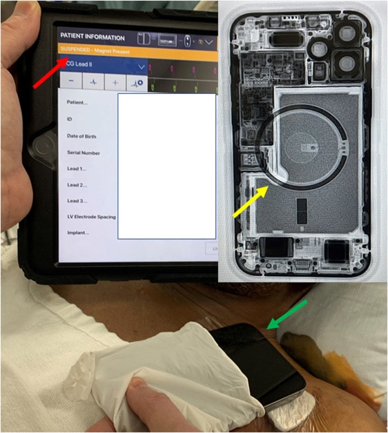 iPhone 12 Magnet Inhibit Life Saving Therapy